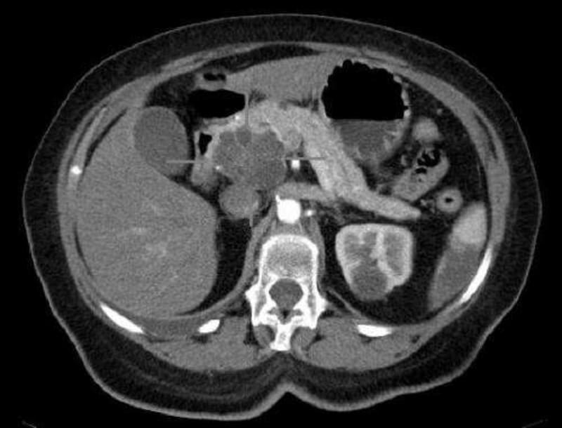 New Biomarkers Detect Pancreatic Cancer Years Earlier - Image 3