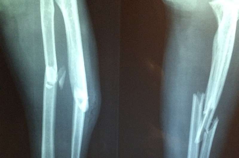 Indigenous Bone Health Study Guides Better Care in Australia - Image 3