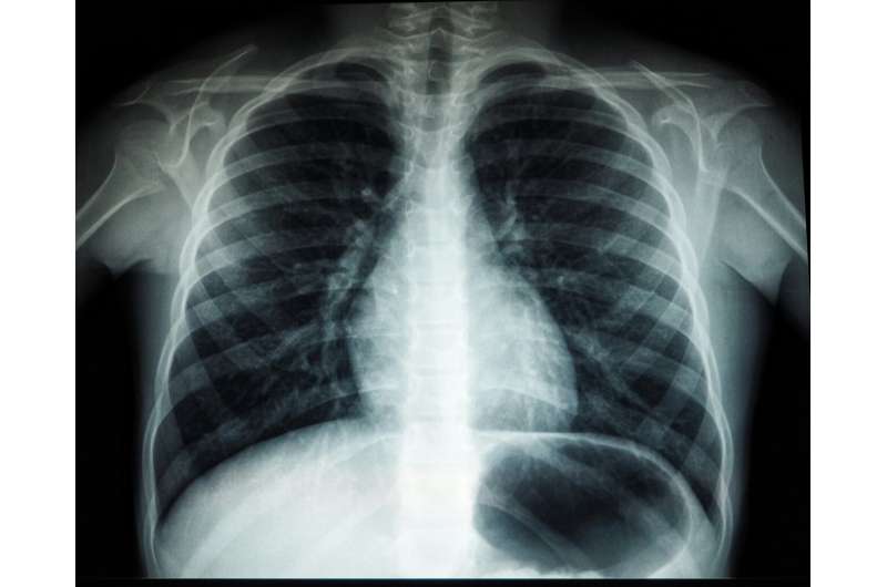 EU Women's Lung Cancer Deaths Finally Leveling Off in 2026 - Image 3