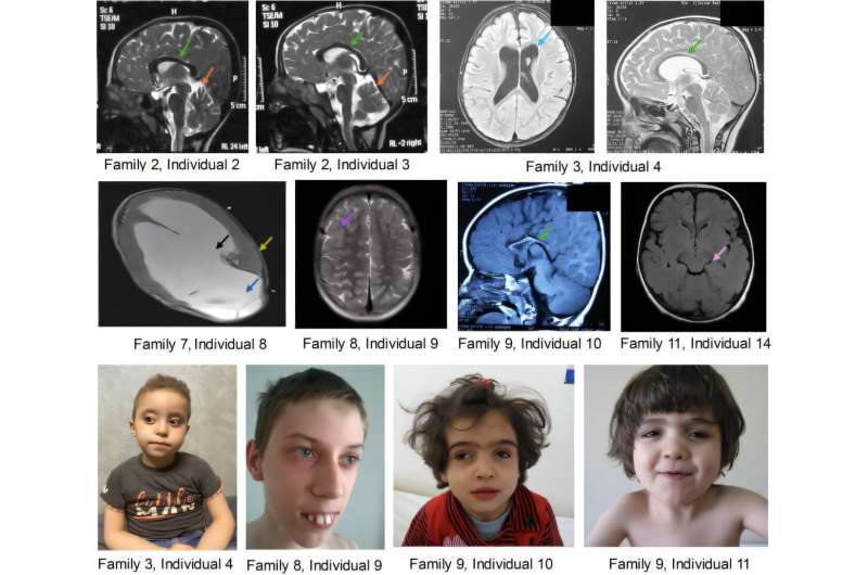 30 Years of Mouse Studies End Diagnostic Odyssey for 18 Kids - Image 2