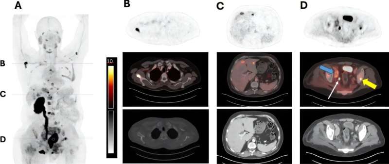 Breakthrough Prostate Cancer Treatment Offers Hope Without Debilitating Side Effects - Image 2