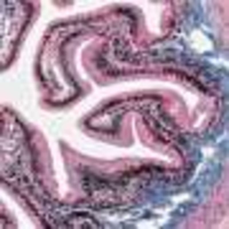 Lab-Grown Mini Tumors Could Personalize Lung Cancer Care - Image 5