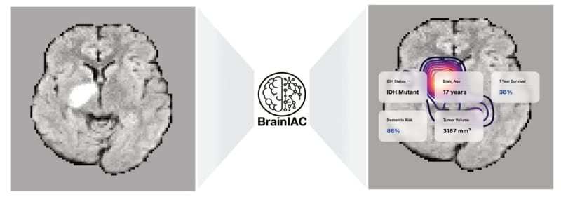 AI Tool Predicts Brain Age and Cancer Survival from MRIs - Image 2
