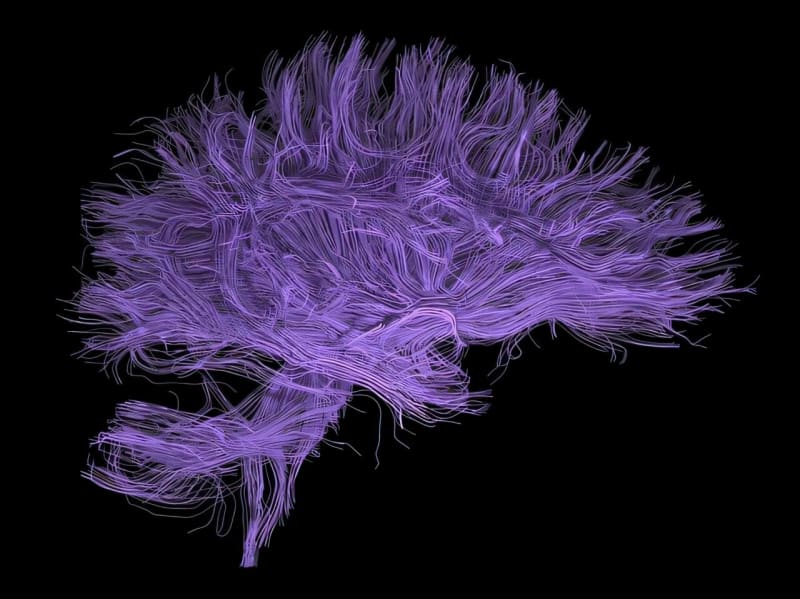 New Drug Combo Speeds Thinking in Schizophrenia Patients