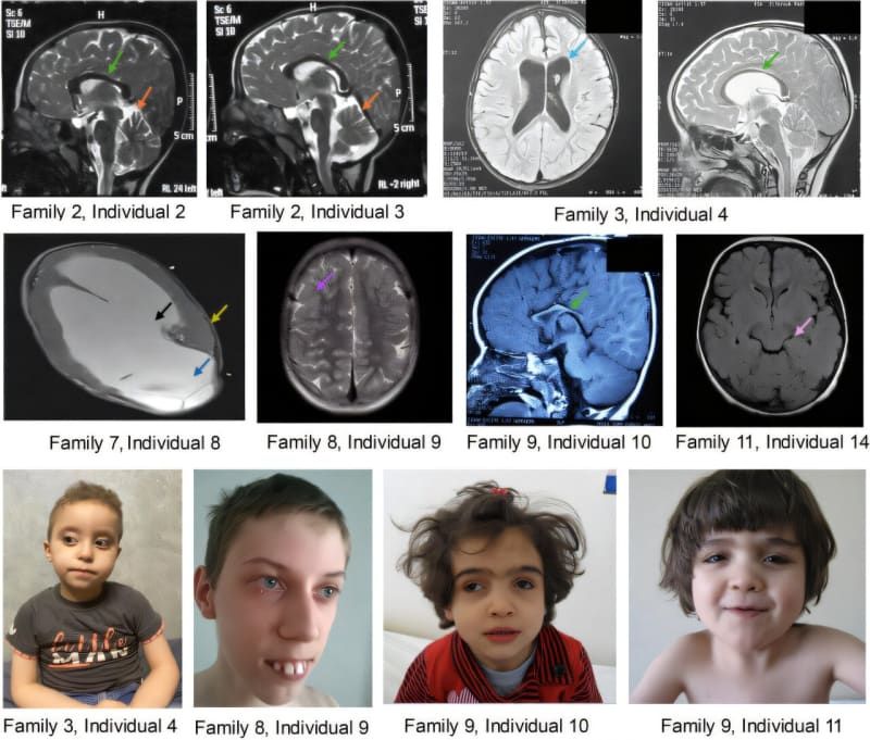 30 Years of Mouse Studies End Diagnostic Odyssey for 18 Kids