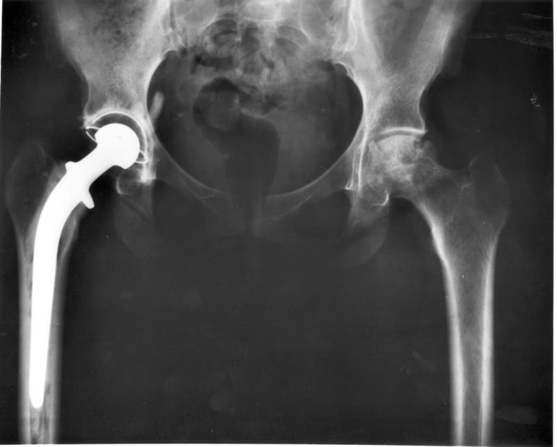 Modern Hip Replacements Last 25+ Years, Study Finds - Image 2