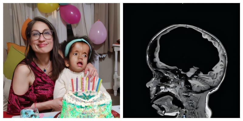 RNA Therapy Cuts Infant Hydrocephalus by 67% in Mice