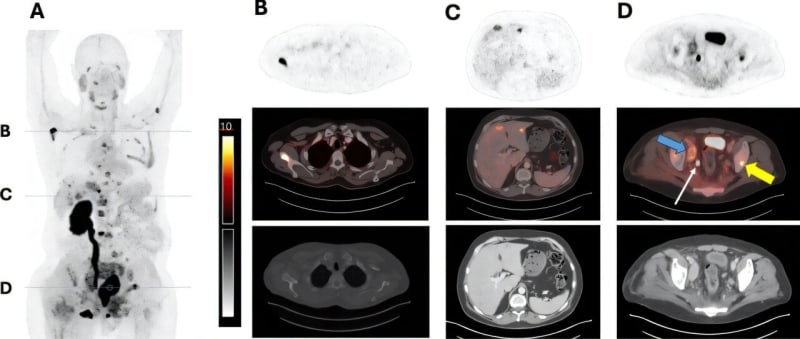 Molecular imaging showing advanced prostate cancer treatment targeting cancer cells while protecting healthy tissue