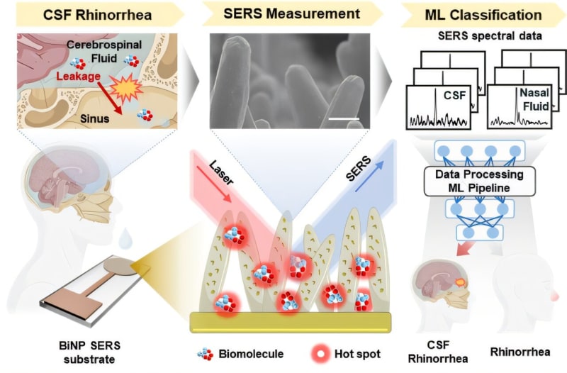 AI Diagnoses Brain Fluid Leaks in Under One Minute