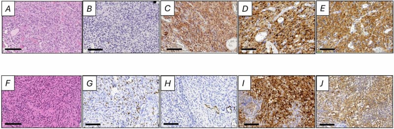 Medical illustration showing meningioma tumor cells in brain tissue membrane layers
