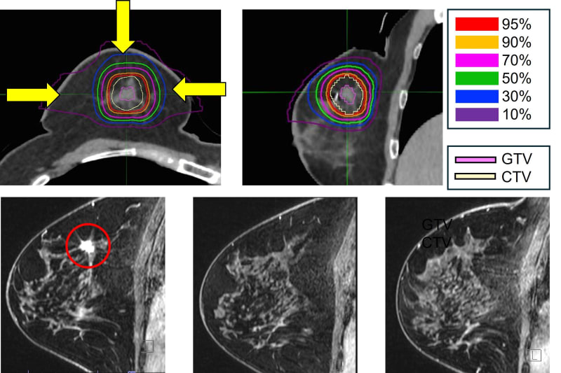 New Radiation Therapy Offers Surgery-Free Breast Cancer Care