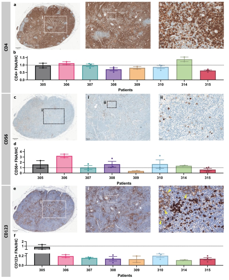 Simple Needle Test May Spare Breast Cancer Patients Surgery