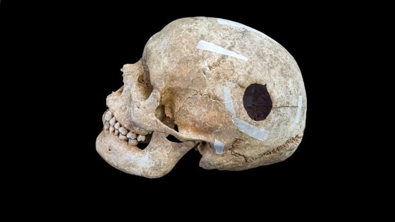 Viking Skull Reveals 9th-Century Brain Surgery Success