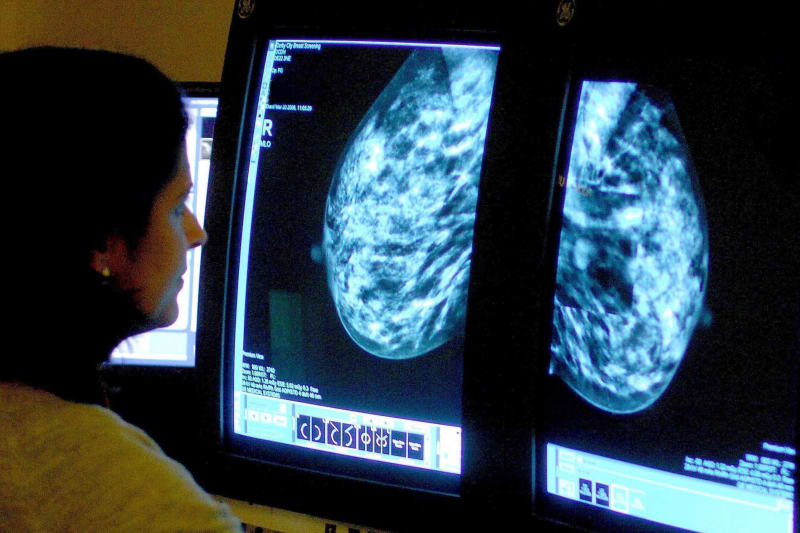AI Breast Cancer Screening Catches 33% More Cases in Sweden - Image 2