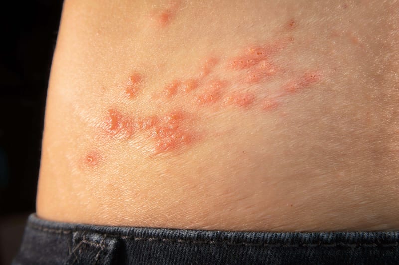Shingles Vaccine May Slow Aging, Study of 3,800 Finds - Image 2
