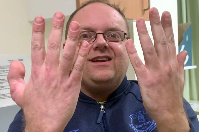 Cobbler Loses Thumb, Replaces It With Toe, Keeps His Dream