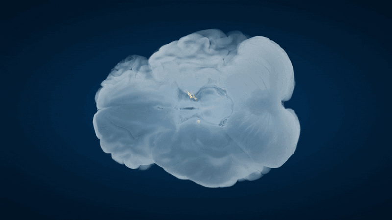 Brain Network Discovery Could Transform Parkinson's Care