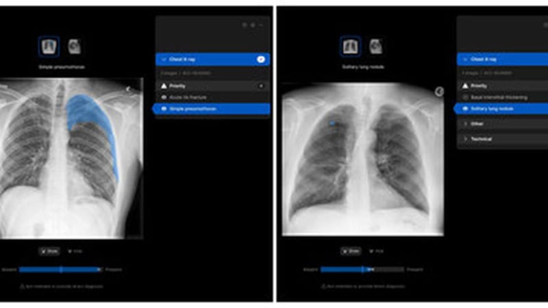 Indian Hospital Network Adds AI to Speed Up X-Ray Reports