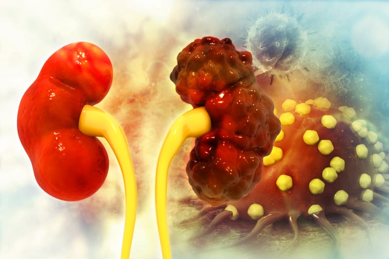 Gene Therapy Shows Promise for Common Kidney Disease