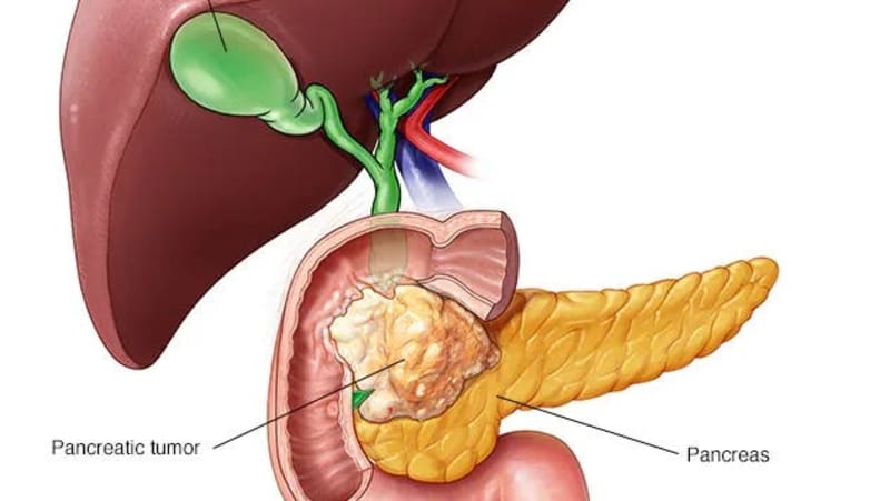 Spanish Scientists Cure Pancreatic Cancer in Mice