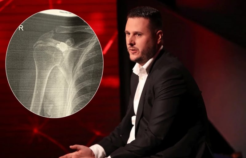 Kosovo Survivor Carried Bullet in Body for 27 Years