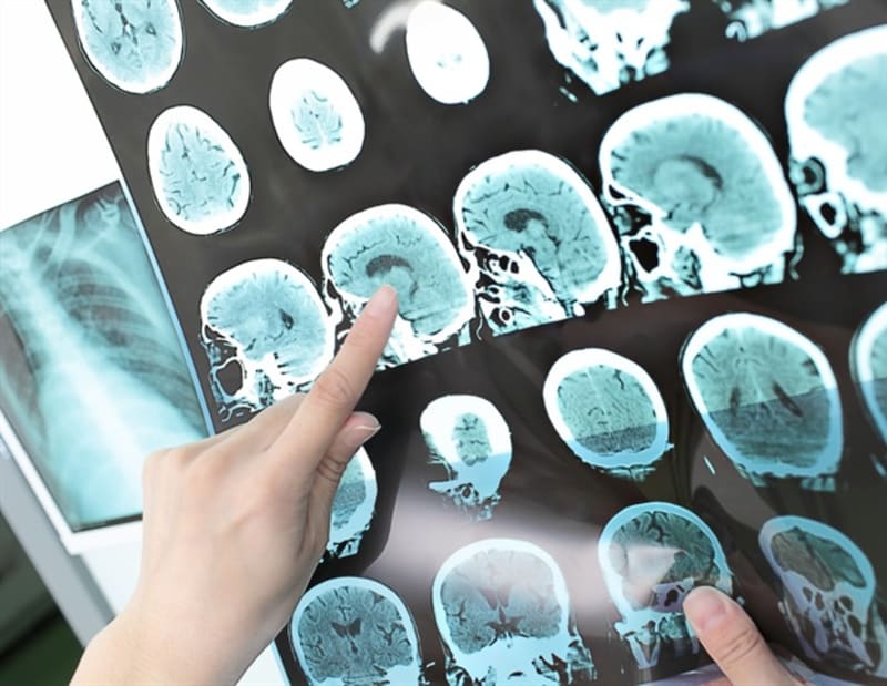 Breakthrough: Scientists Unlock Brain's Healing Potential After Stroke