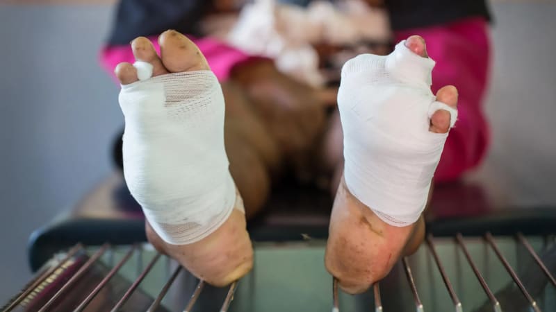 UC Riverside Gel Heals Diabetic Wounds in 23 Days