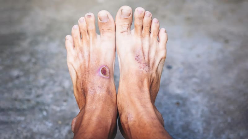 DNA Study Reveals Key to Treating Diabetic Foot Infections