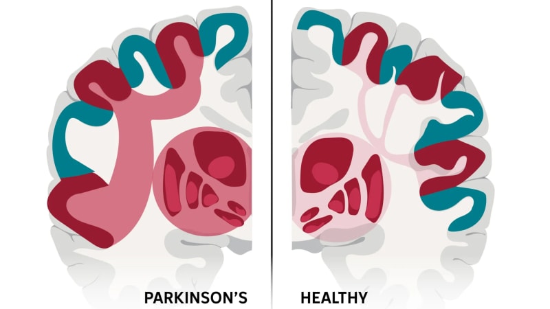 Scientists Find Brain Network Behind Parkinson's Disease