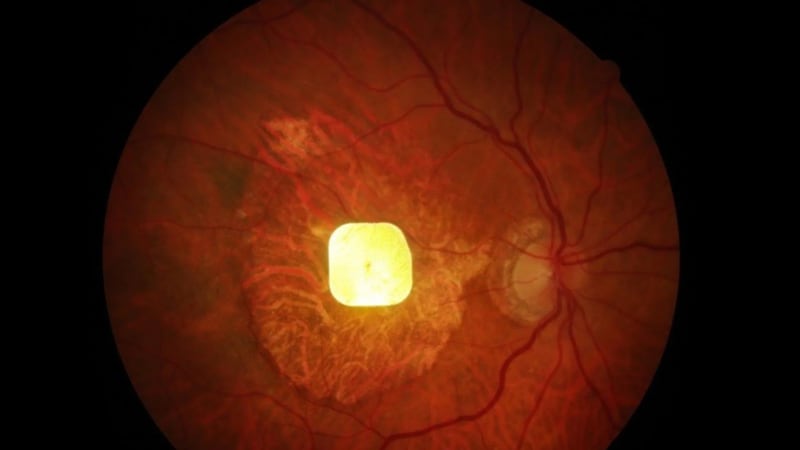 Microscopic wireless retinal implant chip positioned inside a human eye showing restored central vision