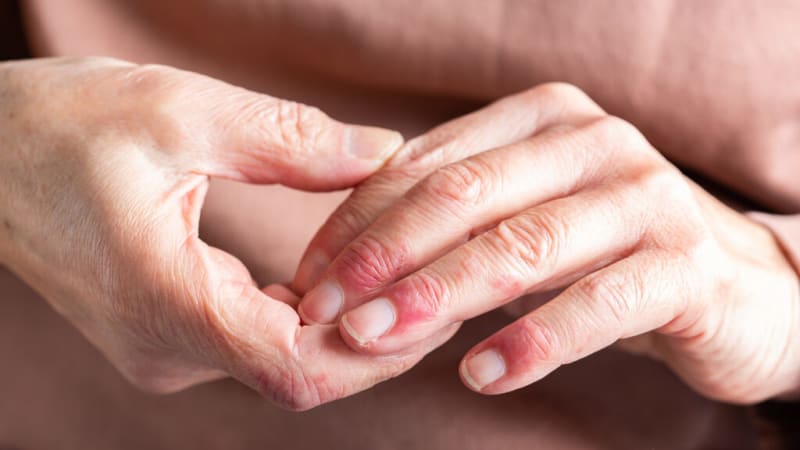 New Eczema Drug Shows Promise in Mid-Stage Trial