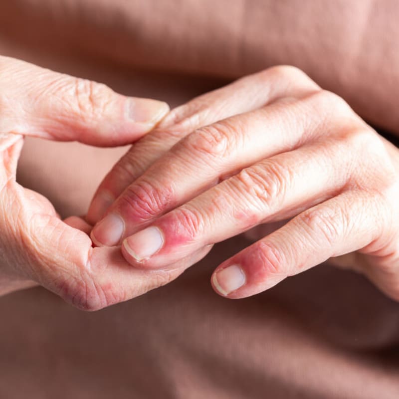 Rare Skin Disease Drug Shows Stunning Results in Trial - Image 2