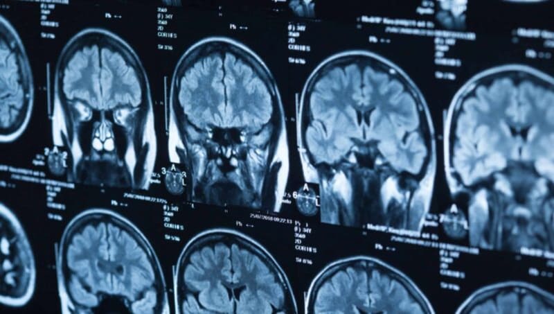 UK Pharma Gets Canadian Patent for Addiction Drug