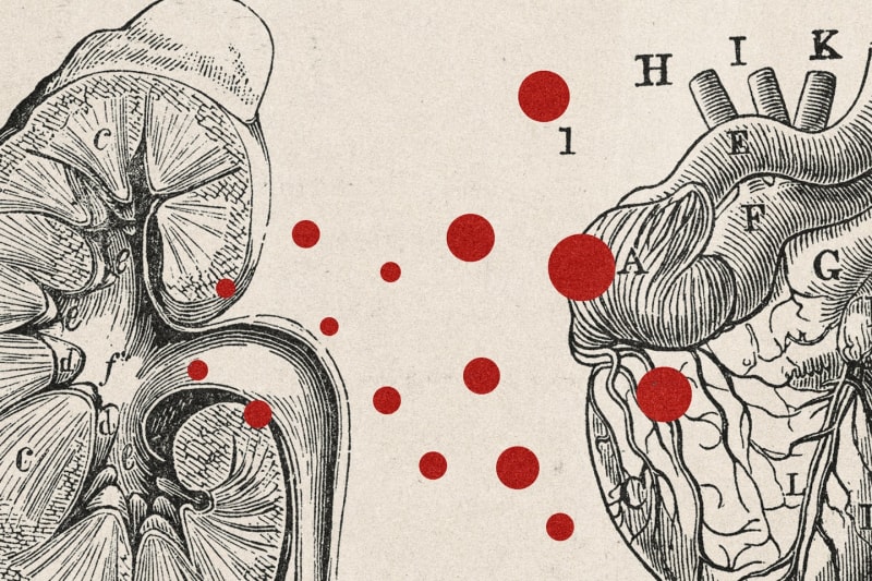 Scientists Find Why Kidney Disease Patients Develop Heart Failure