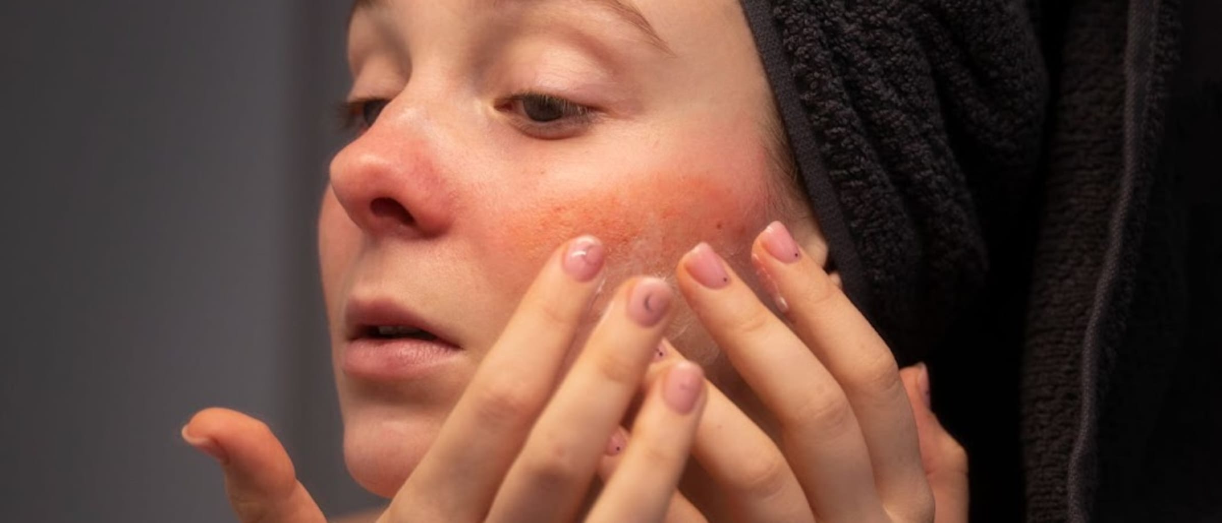 How to Get Rid of Rosacea Quickly?: Here’s the Answer!