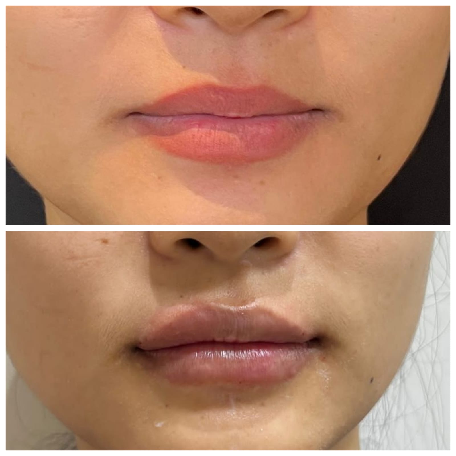 Before and after lip filler