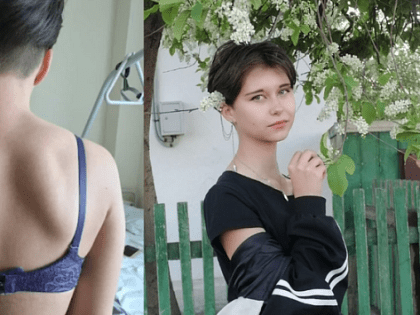 Новосибирские врачи выпрямили спину 15-летней девочки титаном