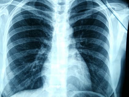 «Поймать» рак. Почему стоит бросить курить и быть внимательным к своим легким