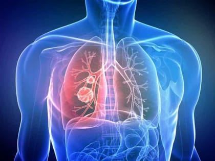 «Поймать» рак. Почему стоит бросить курить и быть внимательным к своим легким