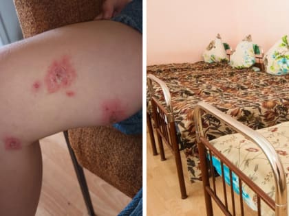 Мальчик из Поморья вернулся из лагеря в Анапе со стрептодермией. Роспотребнадзор проводит проверку