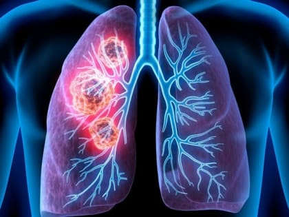 Профилактика рака легкого: Важность ранней диагностики и лечении