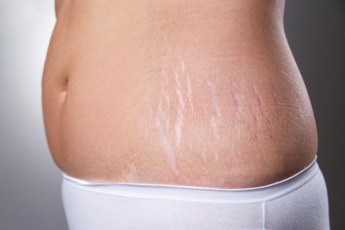 Stretch Marks Reduction