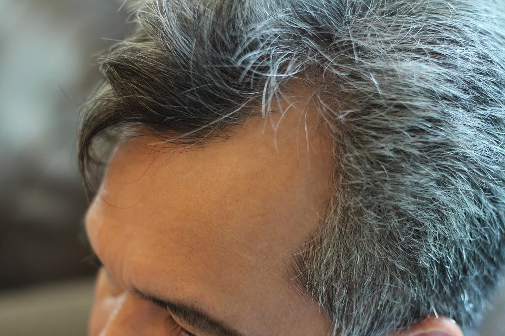 Premature Greying Treatment