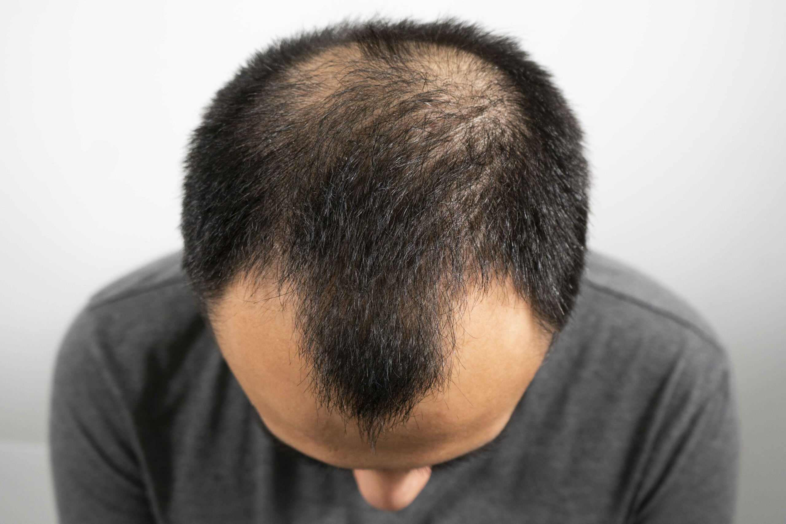 Alopecia Areata Treatment