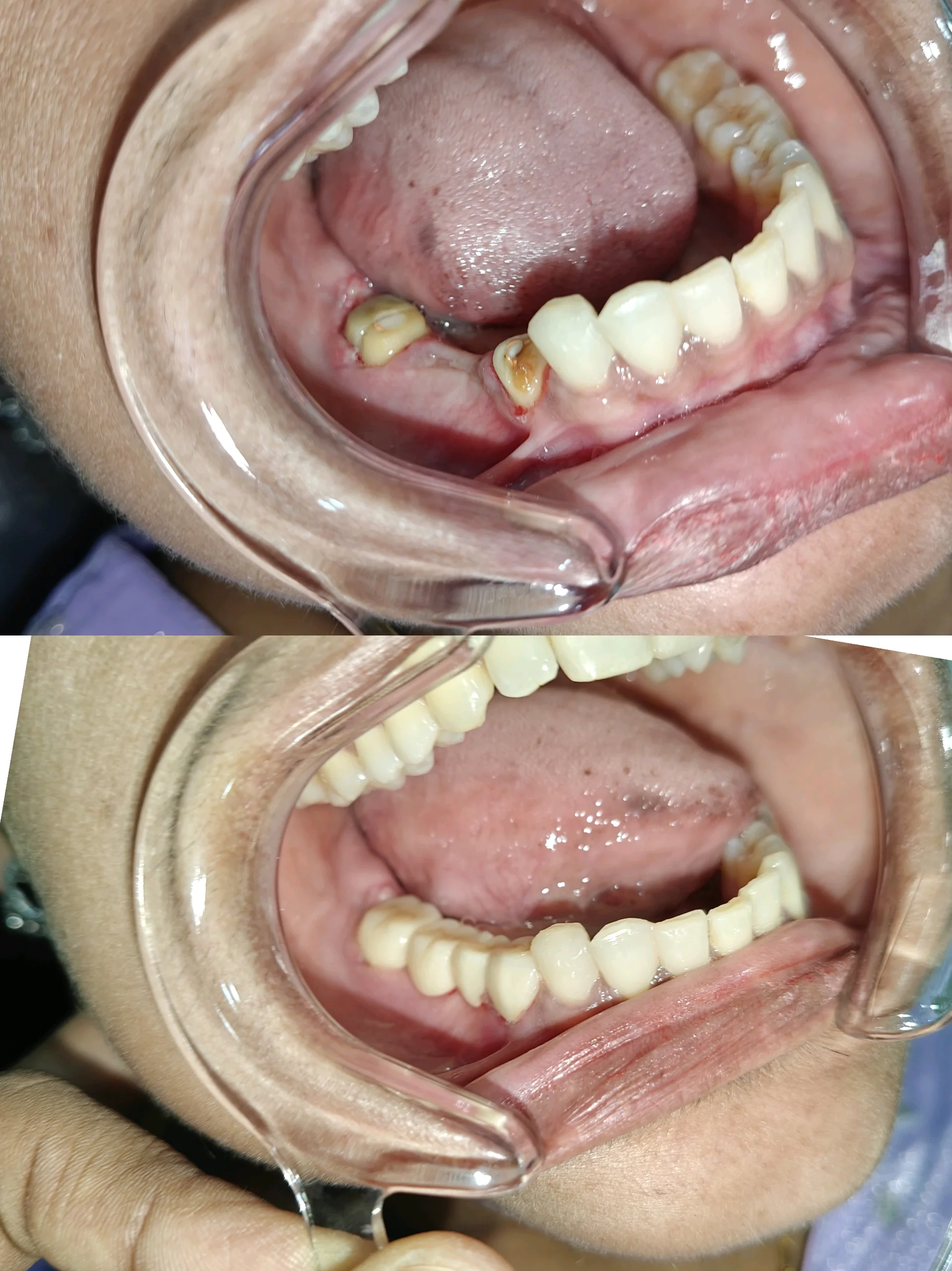 4 unit zirconia bridge