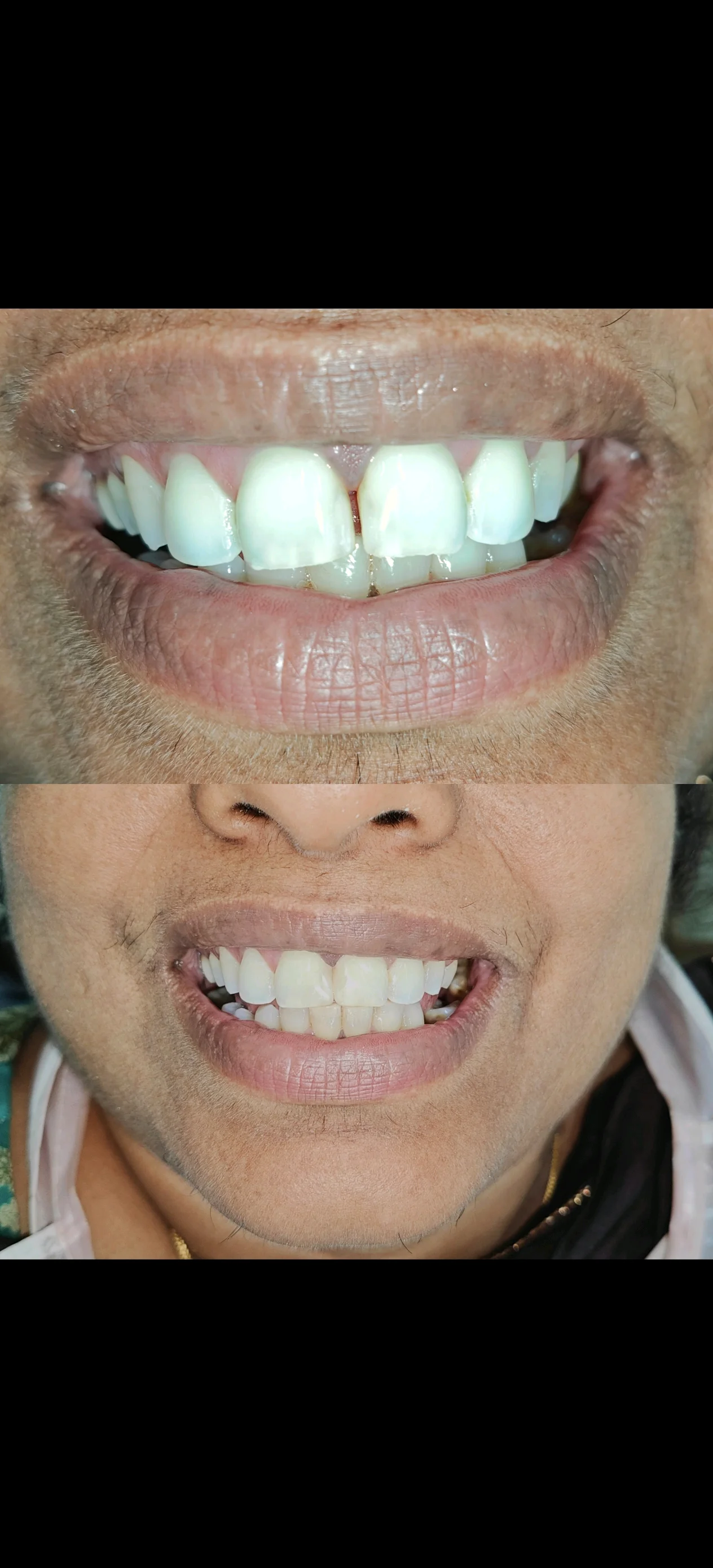 composite Veneering