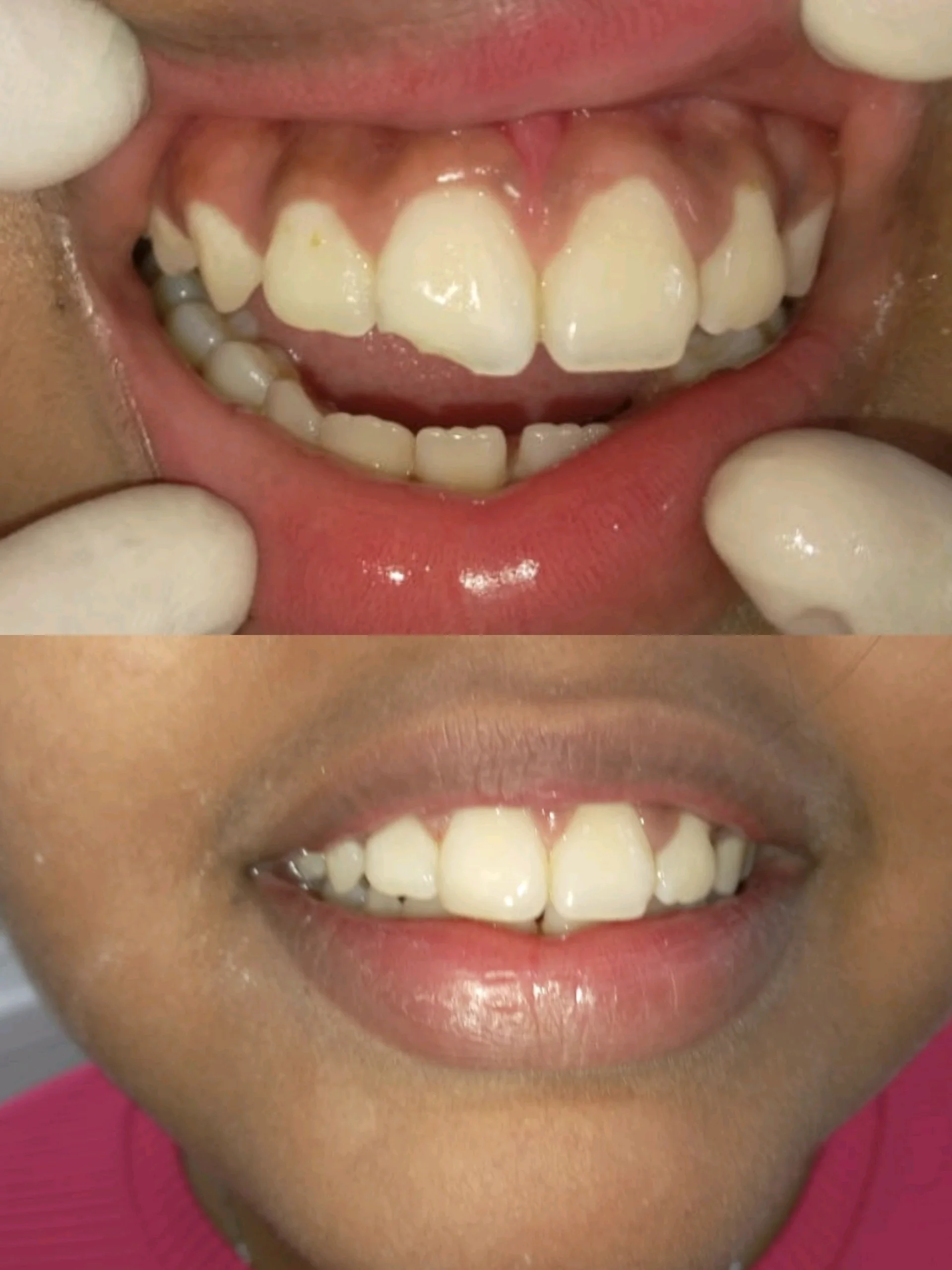composite Veneering