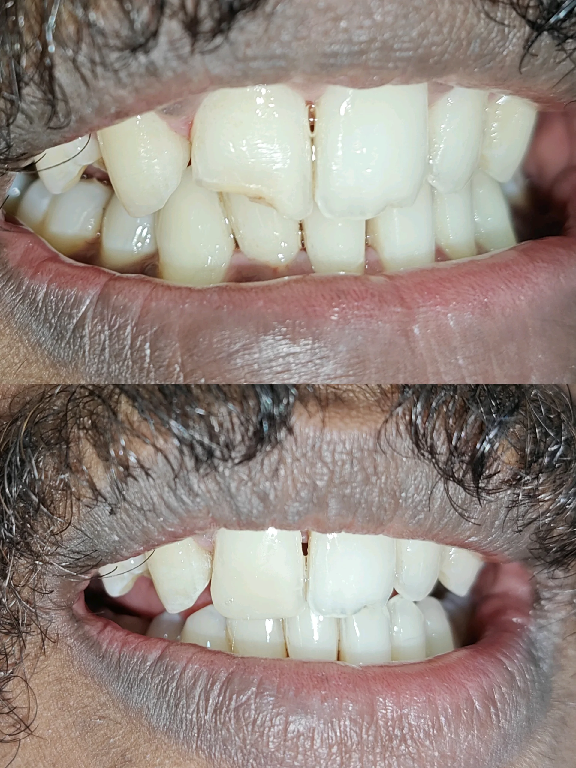 Don't worry about fractured tooth. There's an easy fix