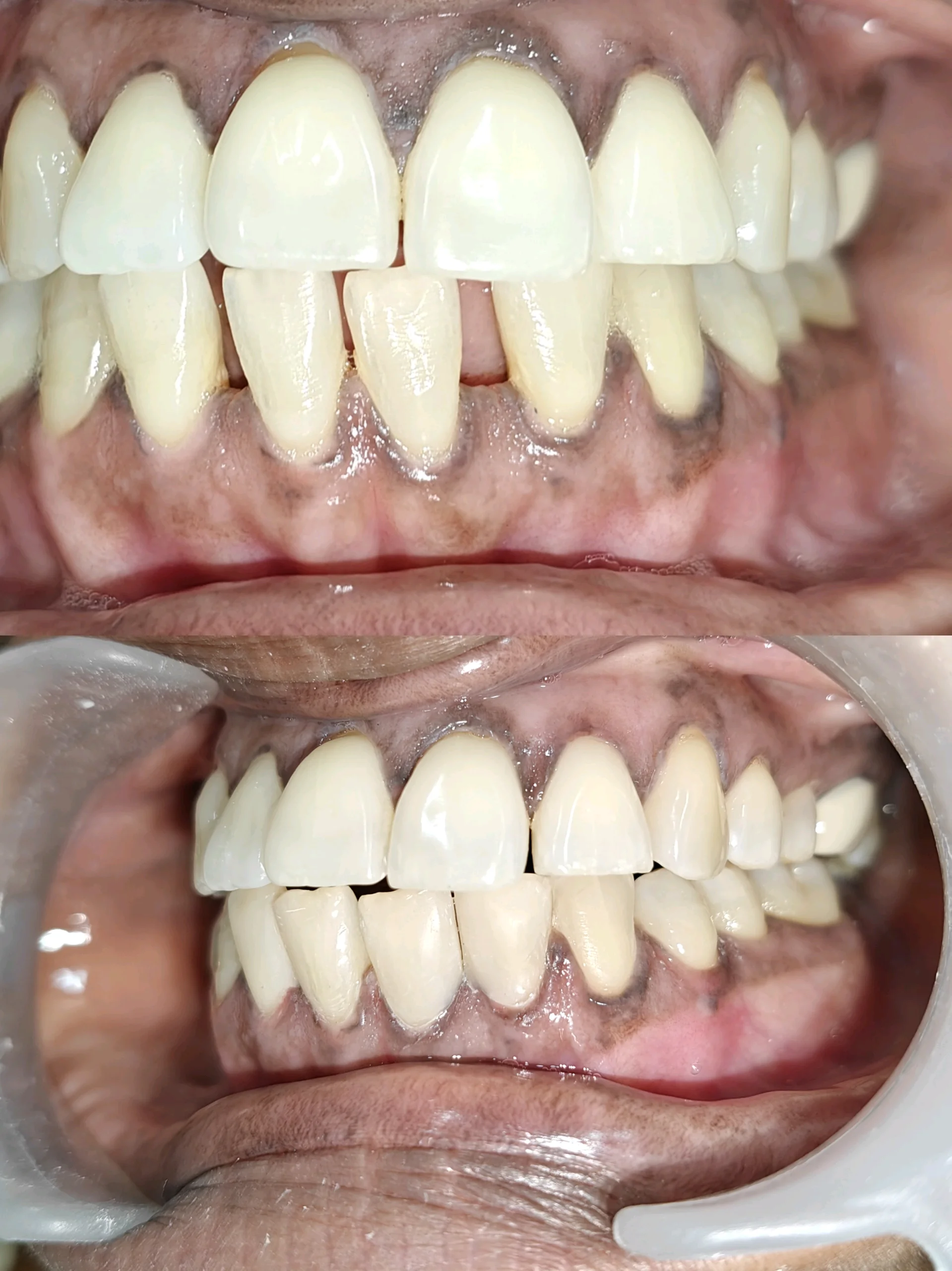 Composite Veneering