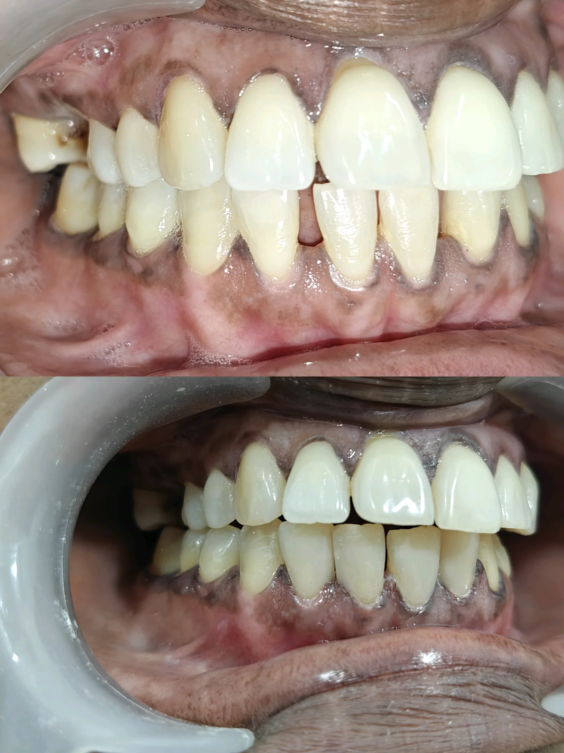 Composite Veneering